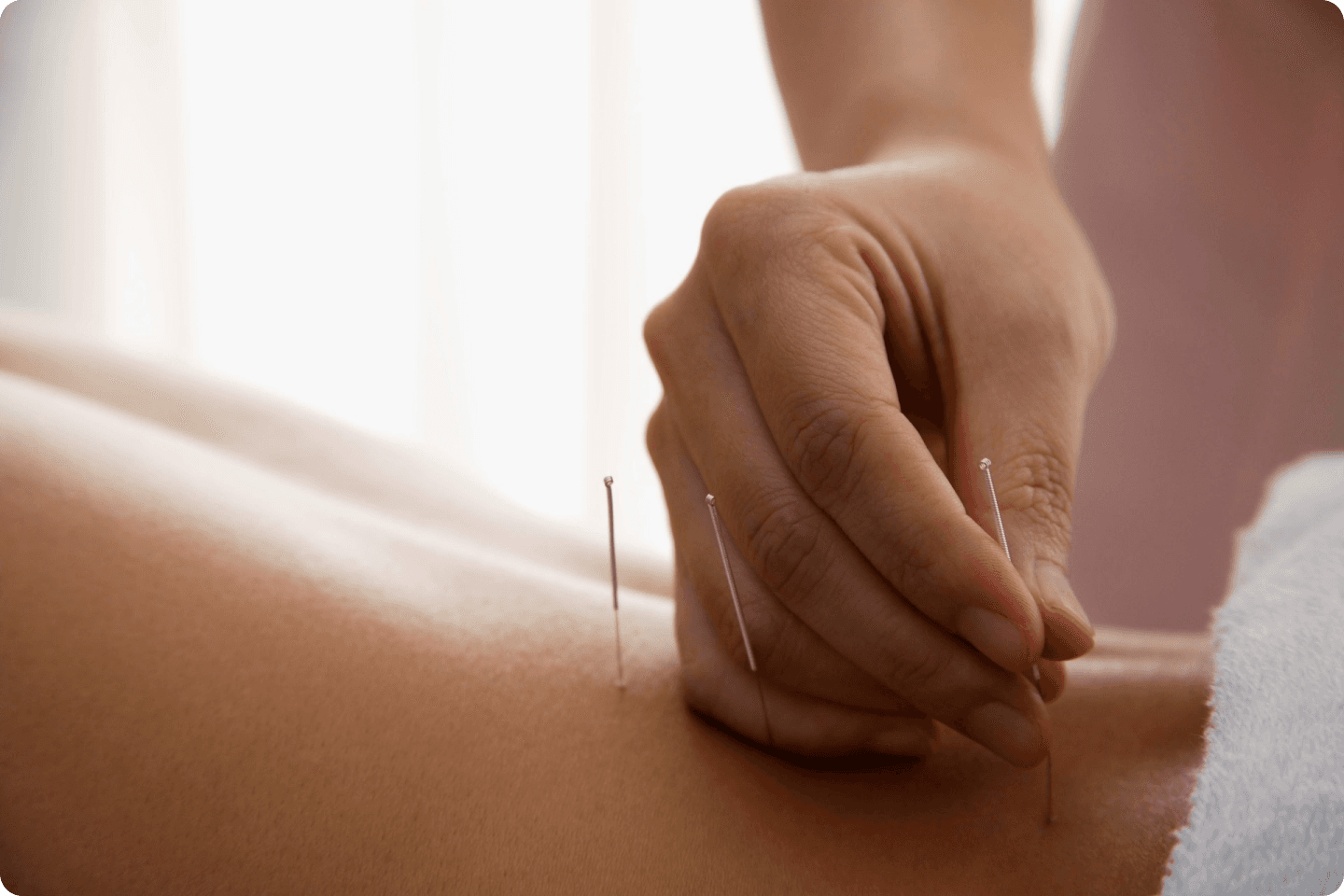 A lady is placing acupuncture needles on the back of someone lying down